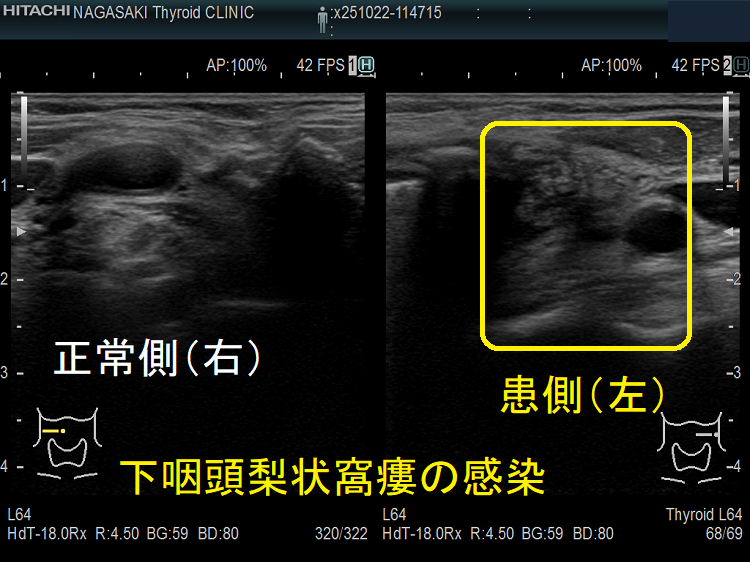 下咽頭梨状窩瘻の感染 エコー (水平断) 下咽頭梨状窩瘻の感染 エコー (水平断)