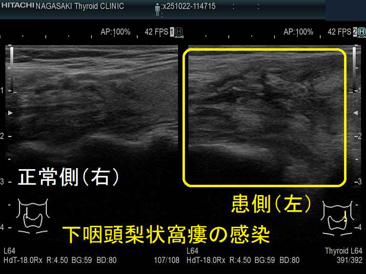 下咽頭梨状窩瘻の感染 エコー (矢状断) 下咽頭梨状窩瘻の感染 エコー (矢状断)