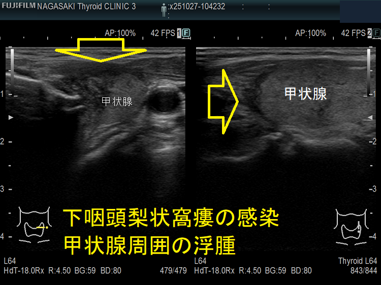下咽頭梨状窩瘻の感染 甲状腺周囲の浮腫 エコー 下咽頭梨状窩瘻の感染 甲状腺周囲の浮腫 エコー