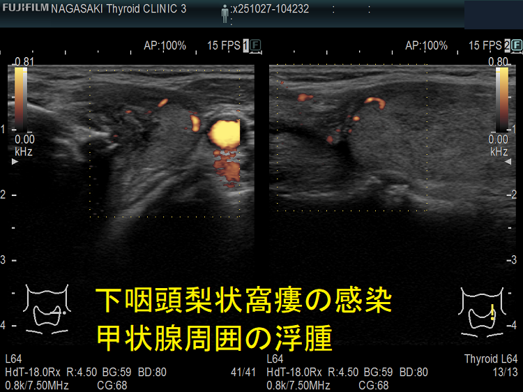 下咽頭梨状窩瘻の感染 甲状腺周囲の浮腫 エコー ドプラーモード 下咽頭梨状窩瘻の感染 甲状腺周囲の浮腫 エコー ドプラーモード