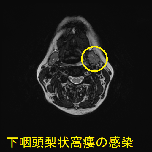下咽頭梨状窩瘻の感染 MRI T2 強調画像 下咽頭梨状窩瘻の感染 MRI T2 強調画像