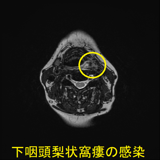 下咽頭梨状窩瘻の感染 MRI T2 強調画像2 下咽頭梨状窩瘻の感染 MRI T2 強調画像2