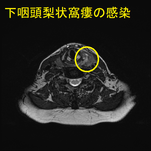 下咽頭梨状窩瘻の感染 MRI T2 強調画像 3 下咽頭梨状窩瘻の感染 MRI T2 強調画像 3