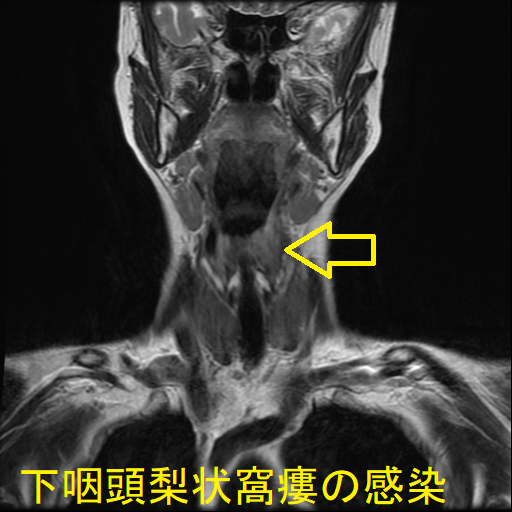 下咽頭梨状窩瘻の感染 MRI T2 強調画像(冠状断) 下咽頭梨状窩瘻の感染 MRI T2 強調画像(冠状断)