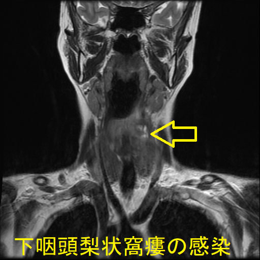 下咽頭梨状窩瘻の感染 MRI T2 強調画像(冠状断)2 下咽頭梨状窩瘻の感染 MRI T2 強調画像(冠状断)2