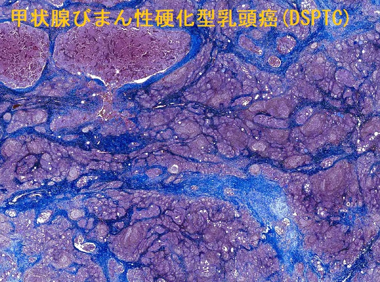 甲状腺びまん性硬化型乳頭癌(DSPTC) 組織像2 甲状腺びまん性硬化型乳頭癌(DSPTC) 組織像2