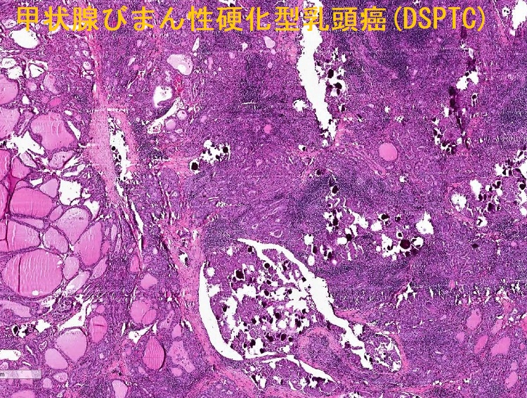 甲状腺びまん性硬化型乳頭癌(DSPTC) 組織像4 甲状腺びまん性硬化型乳頭癌(DSPTC) 組織像4
