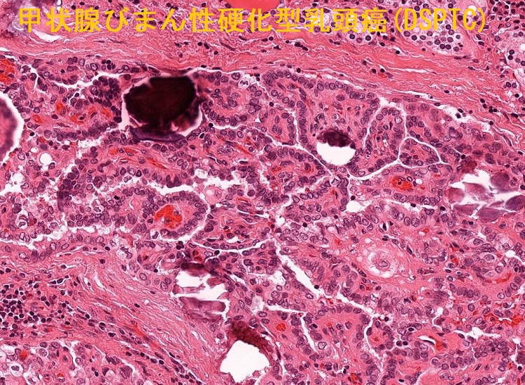 甲状腺びまん性硬化型乳頭癌(DSPTC) 組織像3 甲状腺びまん性硬化型乳頭癌(DSPTC) 組織像3