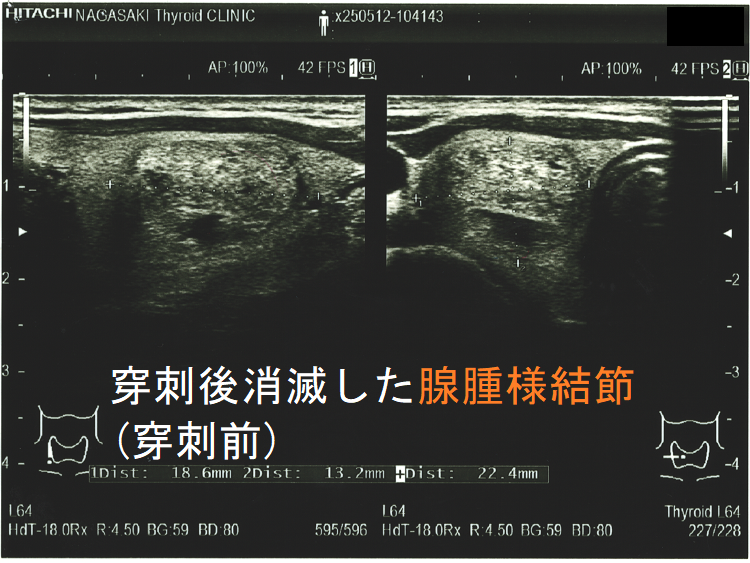 穿刺後消滅した腺腫様結節(穿刺前)2 穿刺後消滅した腺腫様結節(穿刺前)2