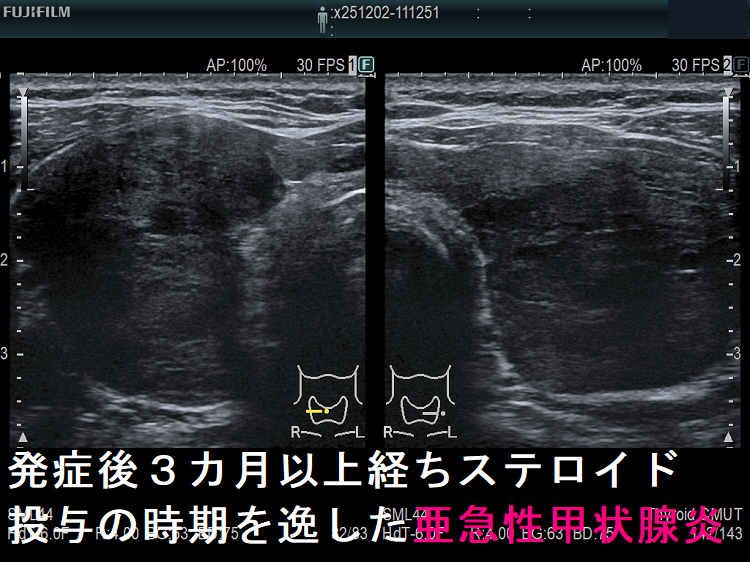 発症後3カ月以上経ちステロイド投与の時期を逸した亜急性甲状腺炎 発症後3カ月以上経ちステロイド投与の時期を逸した亜急性甲状腺炎