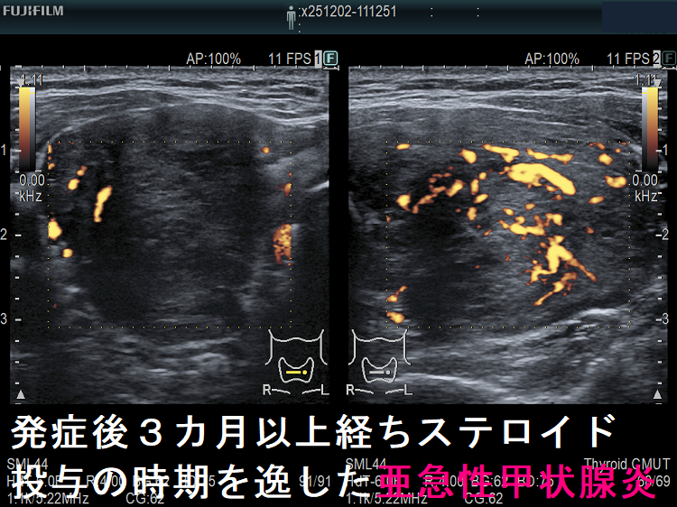 発症後3カ月以上経ちステロイド投与の時期を逸した亜急性甲状腺炎 ドプラーモード 発症後3カ月以上経ちステロイド投与の時期を逸した亜急性甲状腺炎 ドプラーモード