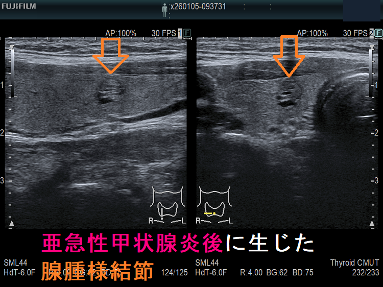 亜急性甲状腺炎後に生じた腺腫様結節 亜急性甲状腺炎後に生じた腺腫様結節
