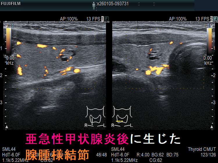 亜急性甲状腺炎後に生じた腺腫様結節 ドプラーモード 亜急性甲状腺炎後に生じた腺腫様結節 ドプラーモード