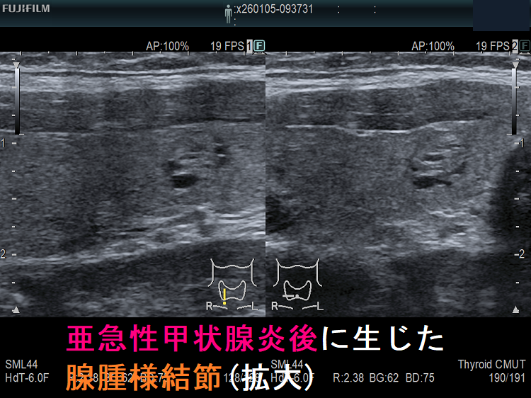 亜急性甲状腺炎後に生じた腺腫様結節(拡大) 亜急性甲状腺炎後に生じた腺腫様結節(拡大)