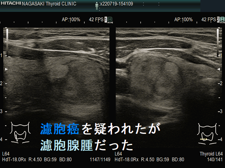 濾胞癌を疑われたが濾胞腺腫だった 超音波(エコー)画像 濾胞癌を疑われたが濾胞腺腫だった 超音波(エコー)画像