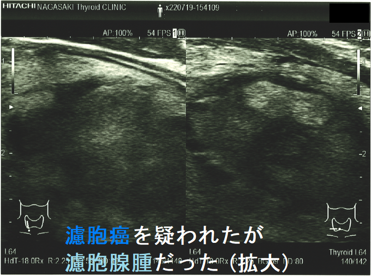 濾胞癌を疑われたが濾胞腺腫だった 超音波(エコー)画像 (拡大) 濾胞癌を疑われたが濾胞腺腫だった 超音波(エコー)画像 (拡大)