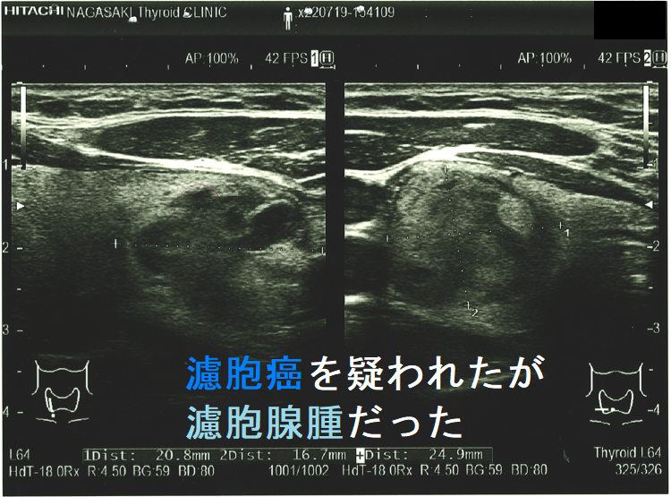 濾胞癌を疑われたが濾胞腺腫だった 超音波(エコー)画像 2 濾胞癌を疑われたが濾胞腺腫だった 超音波(エコー)画像 2