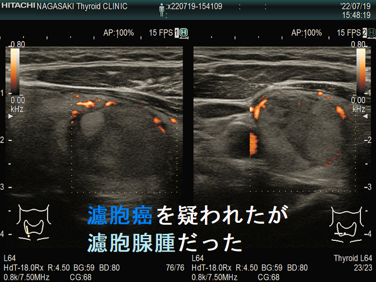 濾胞癌を疑われたが濾胞腺腫だった 超音波(エコー)画像 2 ドプラーモード 濾胞癌を疑われたが濾胞腺腫だった 超音波(エコー)画像 2 ドプラーモード