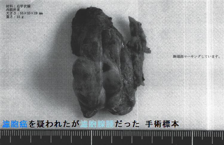 濾胞癌を疑われたが濾胞腺腫だった 手術標本(表面) 濾胞癌を疑われたが濾胞腺腫だった 手術標本(表面)