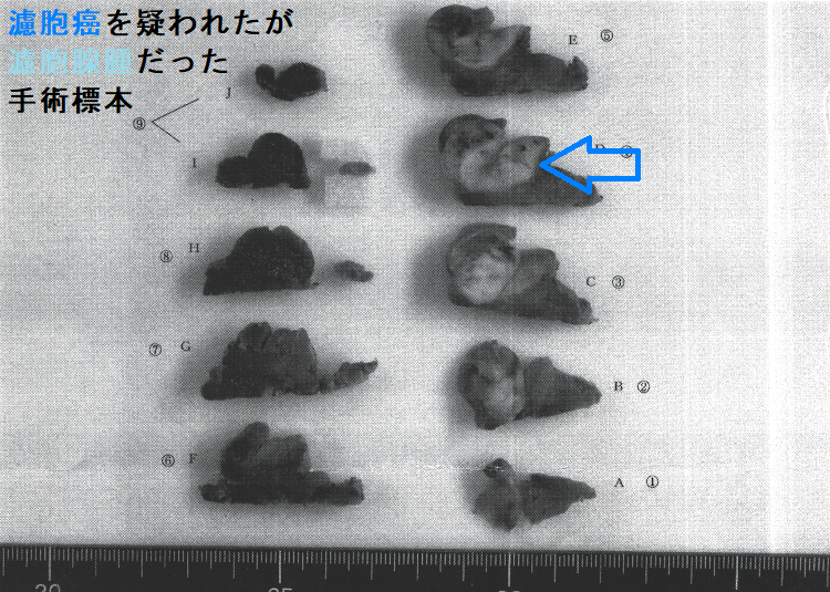 濾胞癌を疑われたが濾胞腺腫だった 手術標本(割面) 濾胞癌を疑われたが濾胞腺腫だった 手術標本(割面)