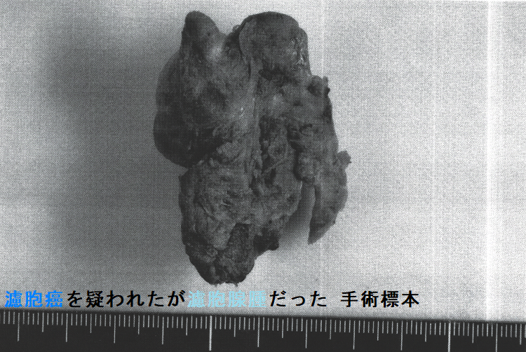 濾胞癌を疑われたが濾胞腺腫だった 手術標本(裏面) 濾胞癌を疑われたが濾胞腺腫だった 手術標本(裏面)