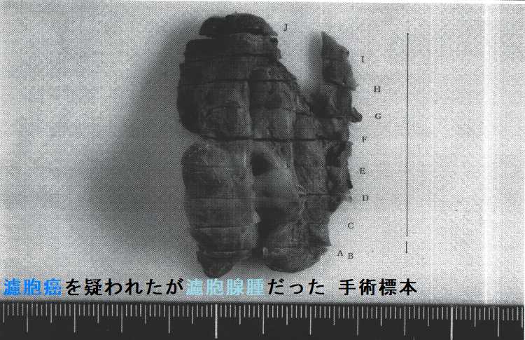 濾胞癌を疑われたが濾胞腺腫だった 手術標本(表面)2 濾胞癌を疑われたが濾胞腺腫だった 手術標本(表面)2