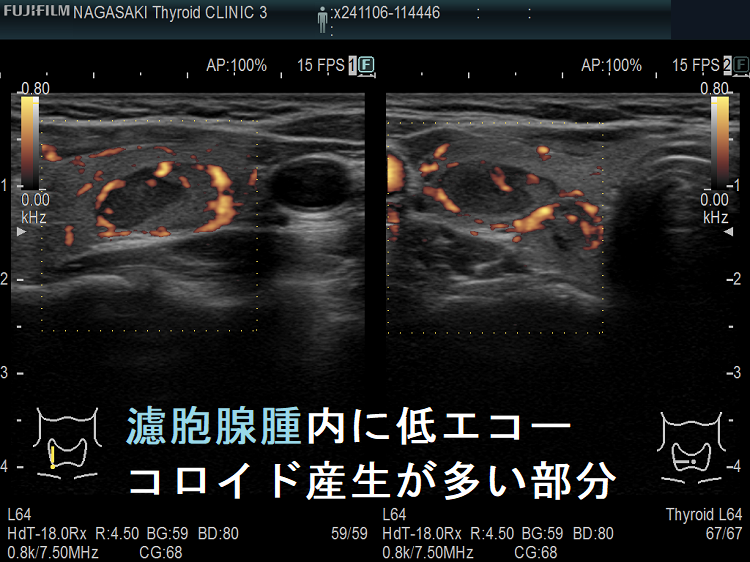 濾胞腺腫内の低エコー領域(コロイド産生が多い部分)ドプラーモード 濾胞腺腫内の低エコー領域(コロイド産生が多い部分)ドプラーモード