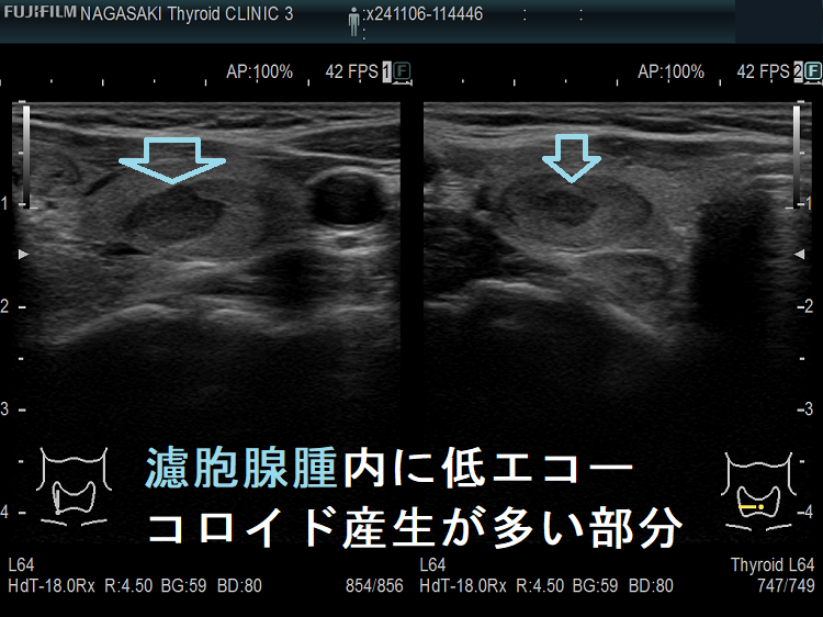濾胞腺腫内の低エコー領域(コロイド産生が多い部分) 濾胞腺腫内の低エコー領域(コロイド産生が多い部分)