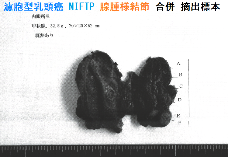 濾胞型乳頭癌 NIFTP 腺腫様結節 合併 摘出標本 濾胞型乳頭癌 NIFTP 腺腫様結節 合併 摘出標本