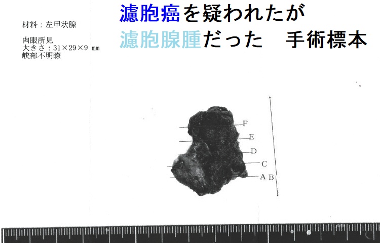 濾胞癌を疑われたが濾胞腺腫だった 手術標本 濾胞癌を疑われたが濾胞腺腫だった 手術標本