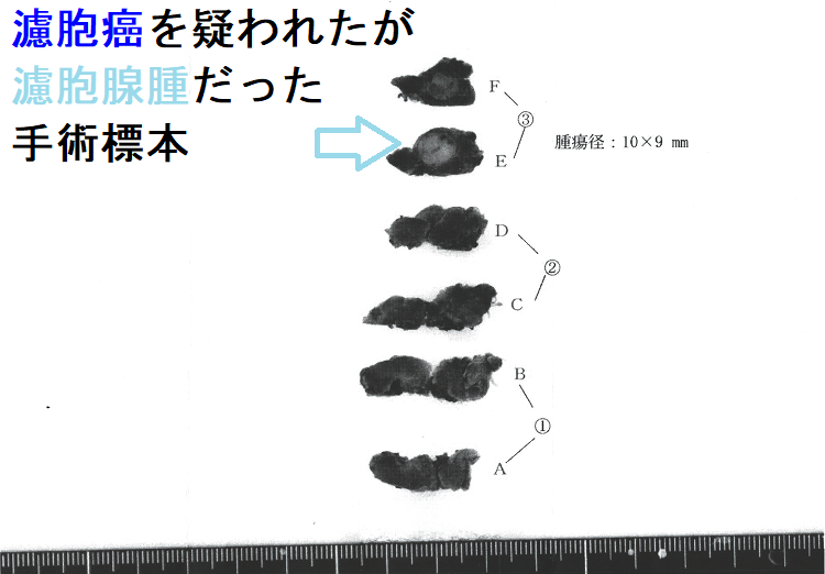 濾胞癌を疑われたが濾胞腺腫だった 手術標本(割面) 濾胞癌を疑われたが濾胞腺腫だった 手術標本(割面)