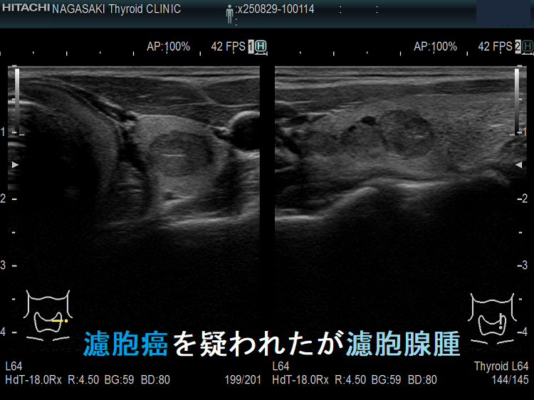 濾胞癌を疑われたが濾胞腺腫 超音波(エコー)画像 濾胞癌を疑われたが濾胞腺腫 超音波(エコー)画像