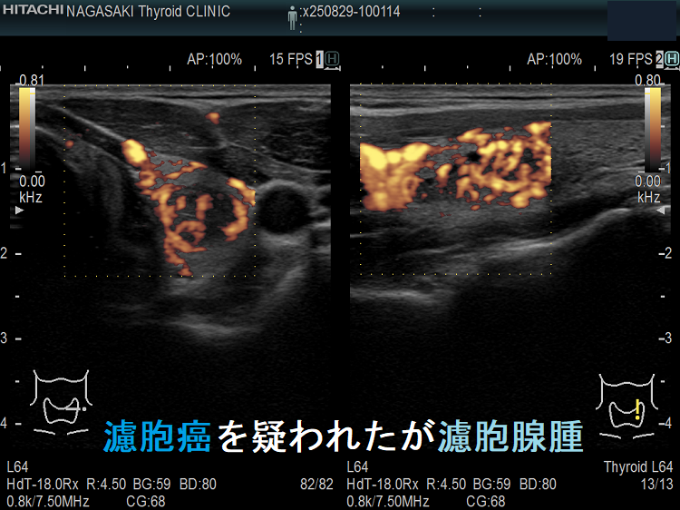 濾胞癌を疑われたが濾胞腺腫 超音波(エコー)画像ドプラーモード 濾胞癌を疑われたが濾胞腺腫 超音波(エコー)画像ドプラーモード