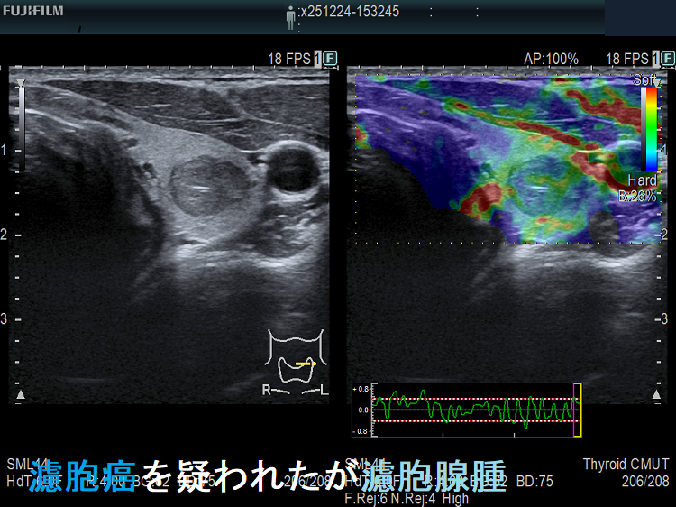 濾胞癌を疑われたが濾胞腺腫 エラストグラフィー 濾胞癌を疑われたが濾胞腺腫 エラストグラフィー