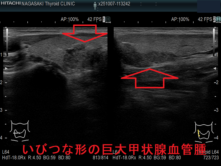いびつな形の巨大甲状腺血管腫 いびつな形の巨大甲状腺血管腫