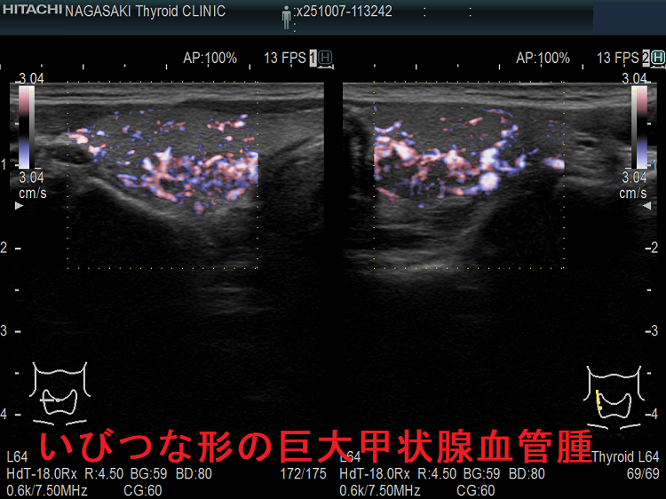 いびつな形の巨大甲状腺血管腫 eFlow いびつな形の巨大甲状腺血管腫 eFlow