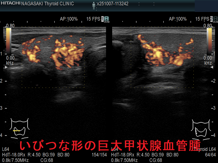 いびつな形の巨大甲状腺血管腫 パワードプラー いびつな形の巨大甲状腺血管腫 パワードプラー
