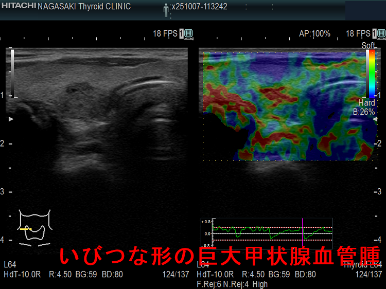 いびつな形の巨大甲状腺血管腫 エラストグラフィー いびつな形の巨大甲状腺血管腫 エラストグラフィー