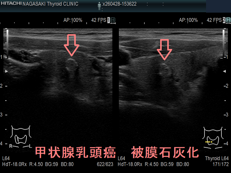 甲状腺乳頭癌 被膜石灰化 甲状腺乳頭癌 被膜石灰化