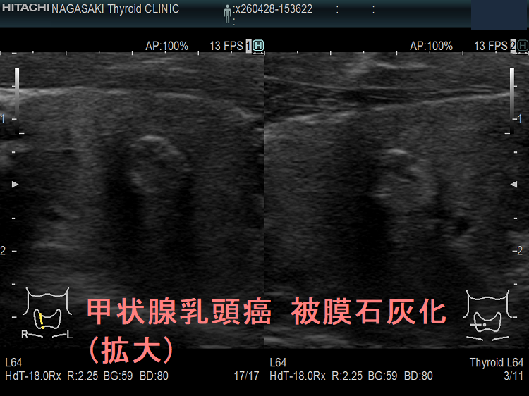 甲状腺乳頭癌 被膜石灰化(拡大) 甲状腺乳頭癌 被膜石灰化(拡大)