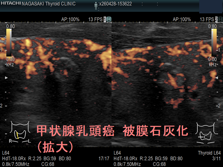 甲状腺乳頭癌 被膜石灰化(拡大) ドプラーモード 甲状腺乳頭癌 被膜石灰化(拡大) ドプラーモード