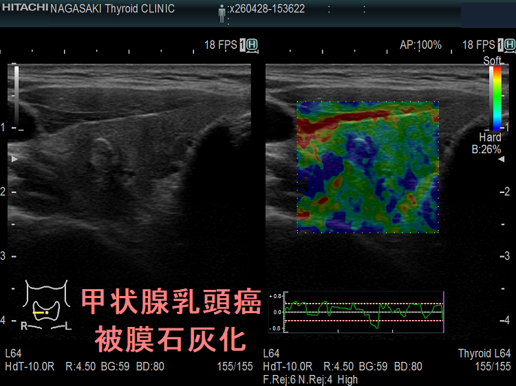 甲状腺乳頭癌 被膜石灰化 エラストグラフィー 甲状腺乳頭癌 被膜石灰化 エラストグラフィー