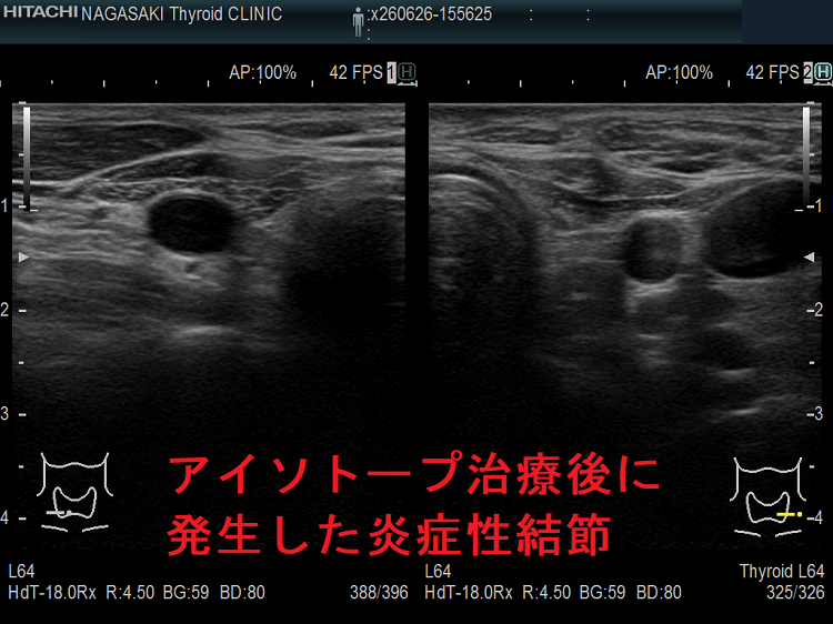 アイソトープ治療後に発生した炎症性結節 アイソトープ治療後に発生した炎症性結節