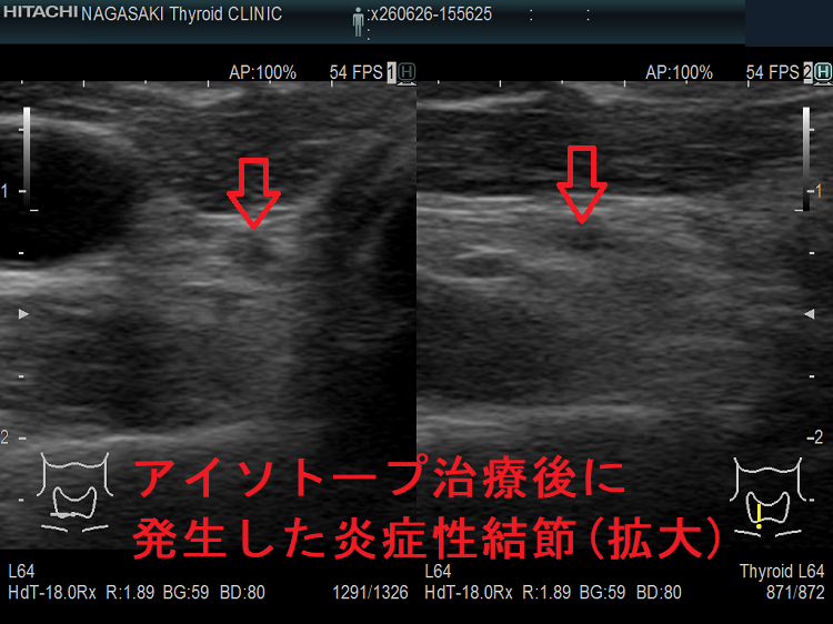 アイソトープ治療後に発生した炎症性結節(拡大) アイソトープ治療後に発生した炎症性結節(拡大)