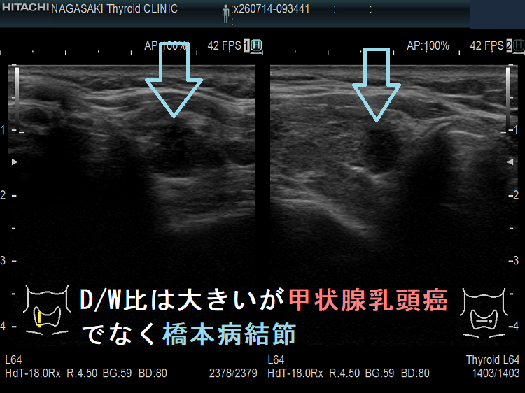D/W比は大きいが甲状腺乳頭癌でなく橋本病結節 D/W比は大きいが甲状腺乳頭癌でなく橋本病結節