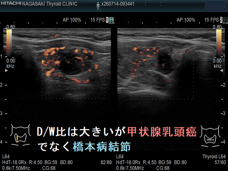 D/W比は大きいが甲状腺乳頭癌でなく橋本病結節 ドプラーモード D/W比は大きいが甲状腺乳頭癌でなく橋本病結節 ドプラーモード