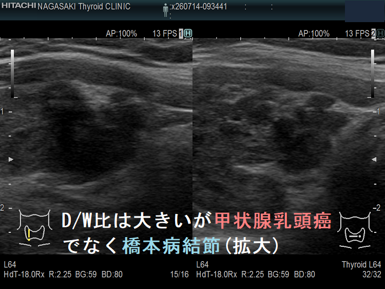D/W比は大きいが甲状腺乳頭癌でなく橋本病結節(拡大) D/W比は大きいが甲状腺乳頭癌でなく橋本病結節(拡大)