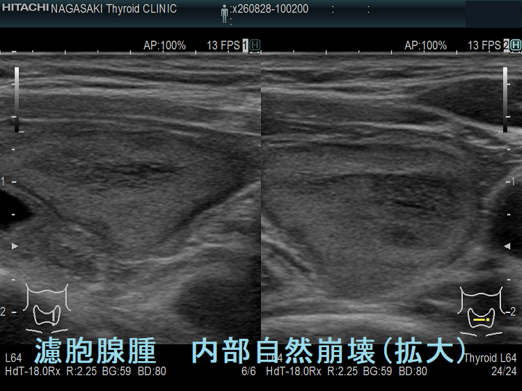 濾胞腺腫 内部自然崩壊(拡大) 濾胞腺腫 内部自然崩壊(拡大)