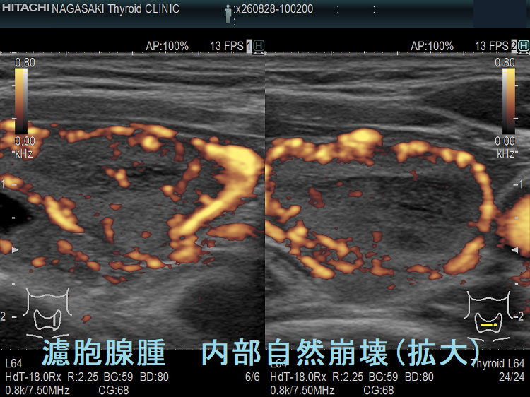 甲状腺濾胞腺腫 内部自然崩壊 ドプラーモード 濾胞腺腫 内部自然崩壊(拡大) ドプラーモード