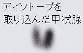 アイソトープ(放射性ヨウ素; I-131)治療 アイソトープ(放射性ヨウ素; I-131)治療